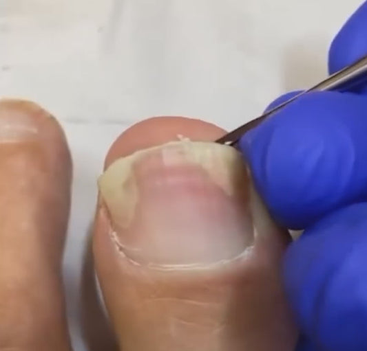 Stiftung Warentest Die besten Mittel gegen Nagelpilz: Diese Präparate wirken